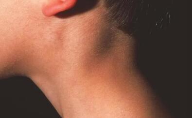 当你的脖子上出现一圈圈的小肉,那么也极有可能是皮下筋膜纤维劳损