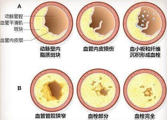 血管硬化可以逆转, 经常做1个动作可软化血管,溶血栓!