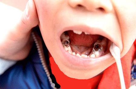 5岁孩子一直很少吃糖, 可是牙齿全坏了, 医生骂家长太无知!