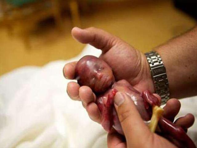 怀孕11周流产胎儿图片图片